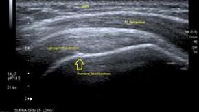 220px-Longitudinal_US_supraspinatus.jpg