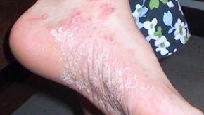PSORIASIS.LH_.jpg