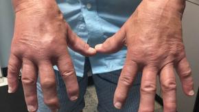 PsA.Hands_.jpg