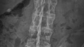 ankylosing%20spondylitis.jpg