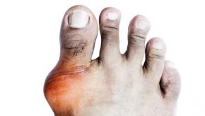 gout.MTP1_.jpg