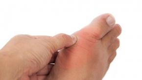 gout.MTP_.jpg