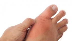 gout.podagra.jpg