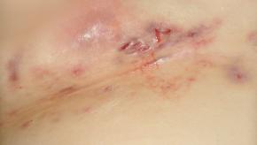 hidradenitis.jpg