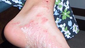 hudsonpsoriasis.jpg