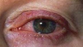 iritis-uveitis-e1333867439592.jpg