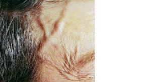 GCA temporal artery