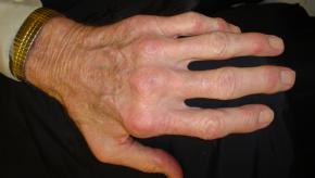 RA Hands Difficult deformity