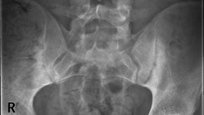 SI,sacroiliitis,erosion