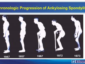 Chronologic Progression of Ankylosing Spondylitis