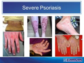 Severe psoriasis