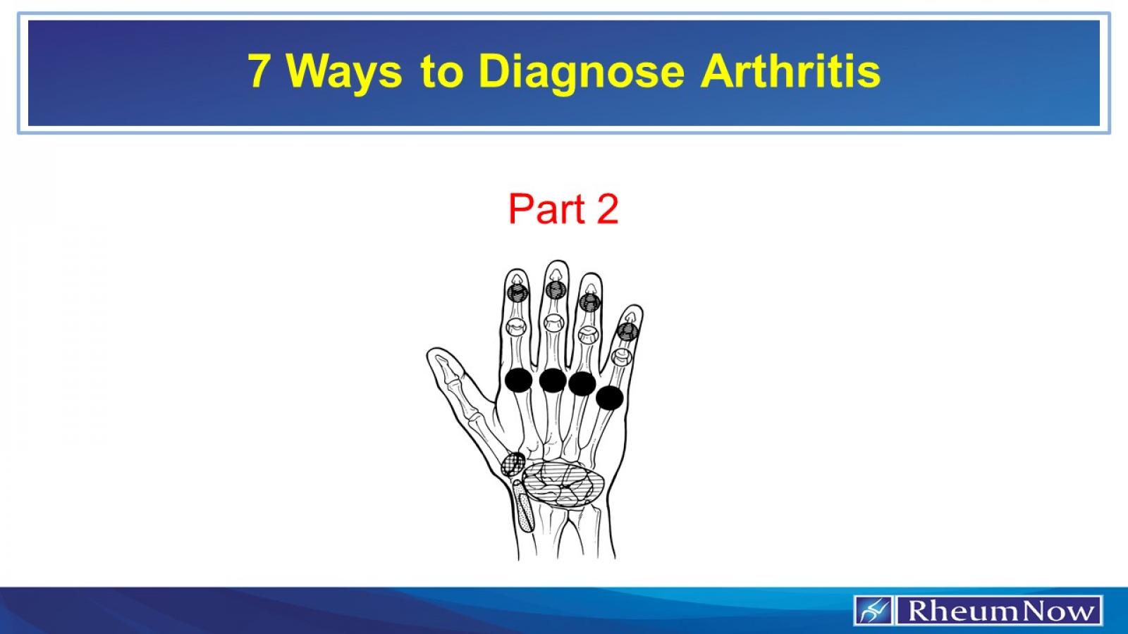 7ways,arthritis